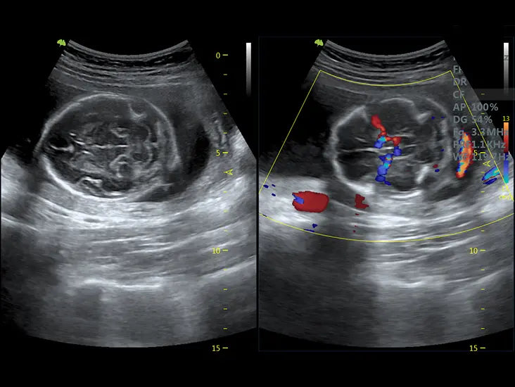 Vinno 5  with linear probe