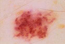 Luminis Dermatoscope
